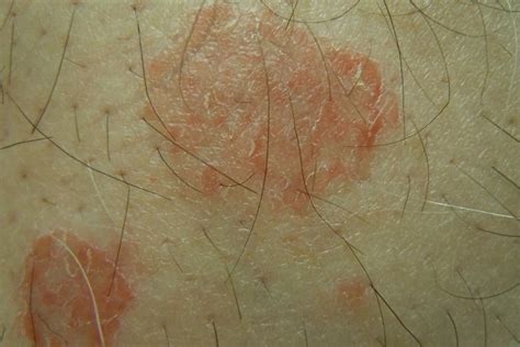 Eczema Numular Como é Feito O Tratamento Tua Saúde