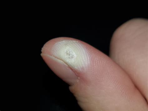 Is This A Good Sign Using Salicylic Acid And Been Freezing This Wart