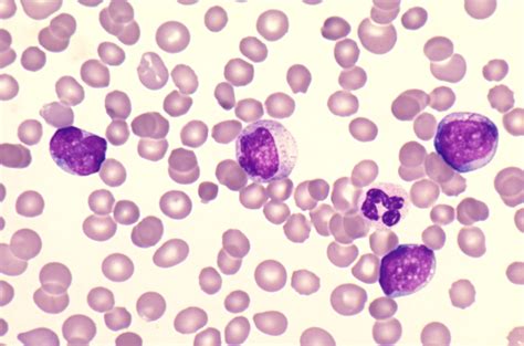 How To Tell Apart Myeloblasts And Lymphoblasts Pathology Student