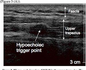 Figure 2 From Assessment Of Myofascial Trigger Points Mtrps A New