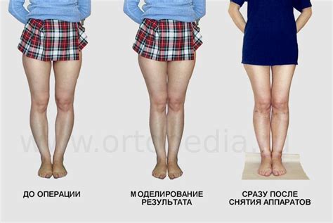 How To Correct Bow Legs In Adults Bow Legs Bowed Legs Bow Legs