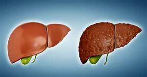 What Is the Best Diet for People With Cirrhosis? Cirrhosis  