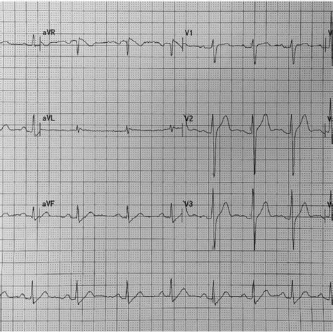 An Electrocardiogram Showing Upsloping St Segment Depression And Normal
