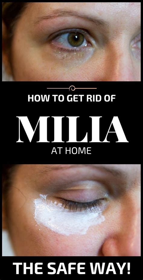 How To Get Rid Of Milia At Home Easily Skin Bumps Skin Spots Face