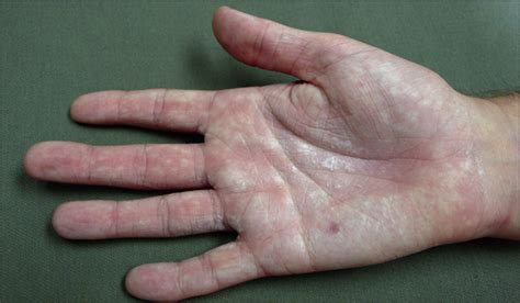 A 16 Year Old With White Plaques On The Palms—quiz Case Dermatology