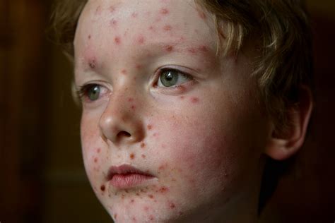 Why “chickenpox Parties” Are A Terrible Idea—in Case Its Not Obvious