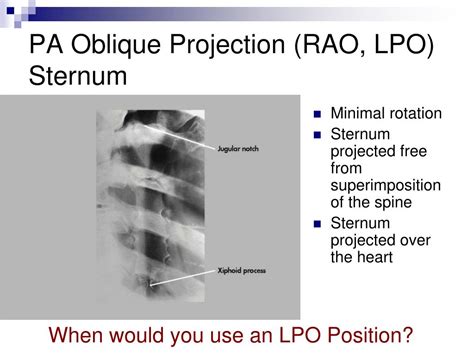 Ppt Bony Thorax Powerpoint Presentation Free Download Id7087072