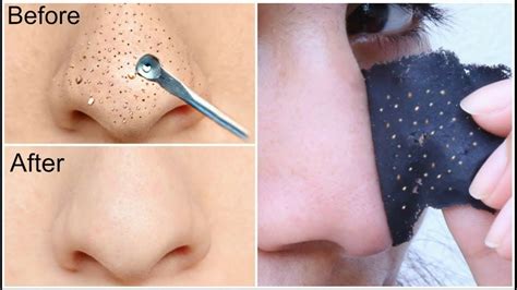 Easy Diy Blackhead Remover Peel Off Mask Removes Blackheads In Just 5