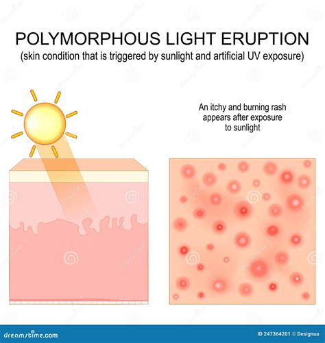 Polymorphic Light Eruption Stock Vector Illustration Of Itchy 247364201
