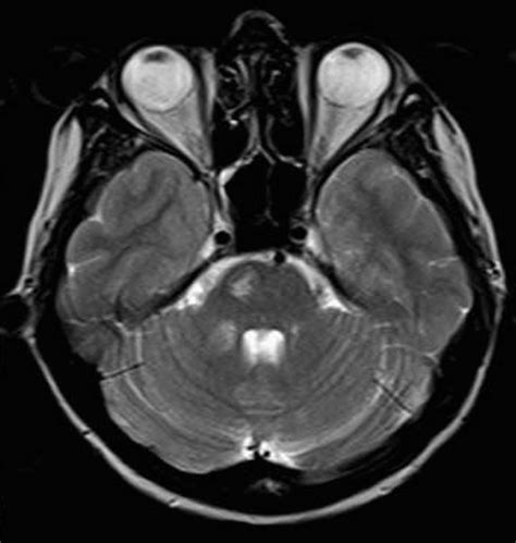 T2 Weighted Magnetic Resonance Imaging Reveals Hyperintense Lesions At
