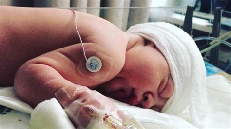 Utah Baby Born Without Skull In The Back Of His Head Defies Odds Cnn