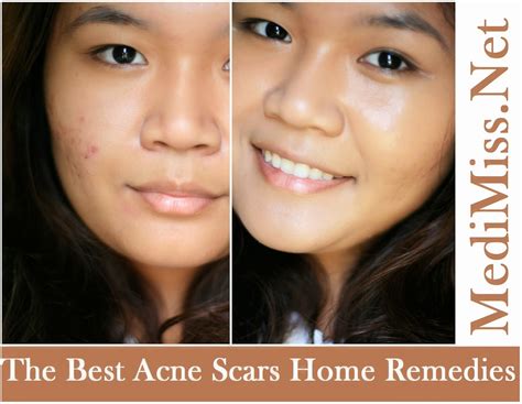 The Best Acne Scars Home Remedies Skinnyzine