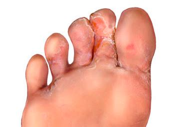 Athletes Foot Tinea Pedis Perform Podiatry