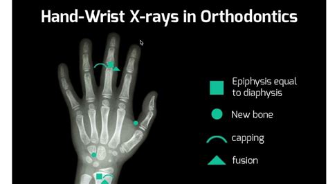 How To Read A Handwrist Xray For Orthodontics Straightsmile Solutions