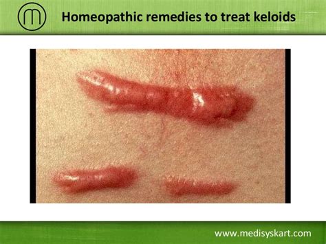 Homeopathic Remedies To Treat Keloids