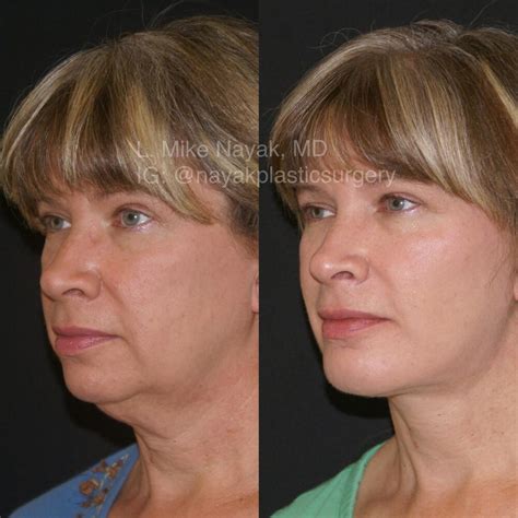 Chin Implants Before And After Patient 13 Nayak Plastic Surgery