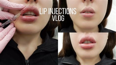 Juvederm Lip Injections Before After Vlog Solange Nicole YouTube