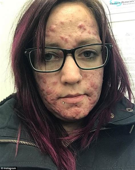 L'antibiorésistance à 3 ou 4 familles d'antibiotiques est de plus en plus fréquente l'acné touche principalement les adolescents, de façon plus ou moins sévère, et plus. Manitoba woman shares her battle against severe acne ...