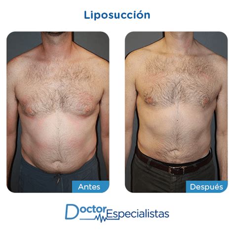 Álbumes 98 Foto Imagenes De Lipoescultura Antes Y Despues Alta