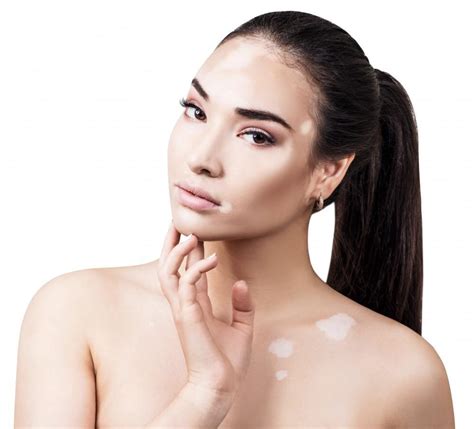 Busque Estos 5 Signos Comunes Del Vitíligo Easton Dermatology