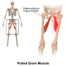 Groin pain might occur immediately after an injury, or pain might come on gradually over a period of weeks or even months. Groin - Wikipedia