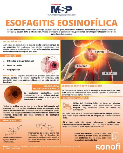 Esofagitis Eosinof Lica Infograf A