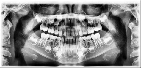 Dental Radiographs X Rays Richmond Dentistry For Children