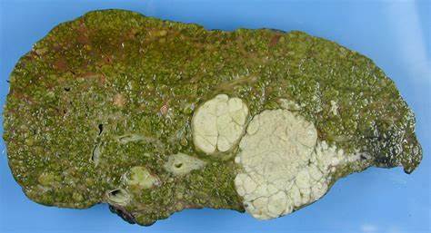 Печень цирроз какой диета Цирроз Печени Стадии Фото — Фото Картинки Цирроз Печени Стадии Фото — Фото Картинки Печень цирроз какой диета