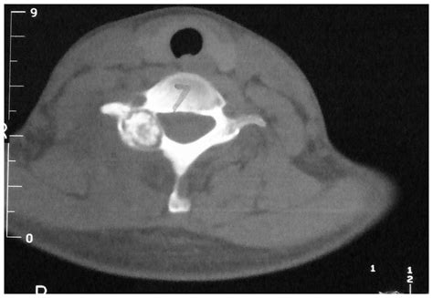 Preoperative Ct Scan Shows A Lesion Located At The Posterior Elements