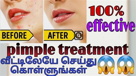 How To Get Rid Pimples Naturally Effective Pimple Treatmentat Home