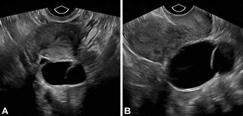 Benign Appearing Incidental Adnexal Cysts At Us Ct And Mri Putting