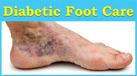 Diabetic Foot Problems Symptoms Treatment And Care Abc Health Youtube
