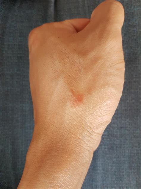 Inchy Red Rashes On Hands From Working In Kitchen That Never Seem To Go