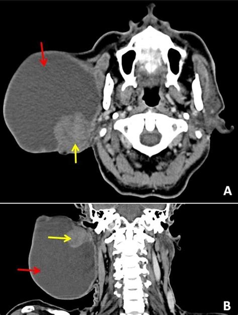 Cureus Colossal Parotid Tumors A Diagnostic And Surgical Challenge