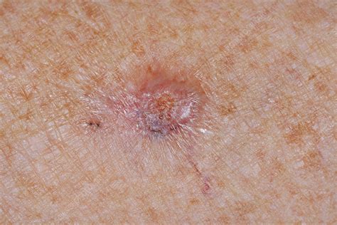 Basal Cell Carcinoma Stock Image C0401419 Science Photo Library