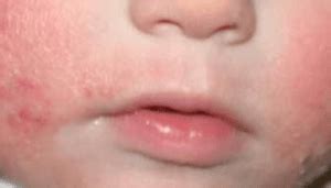 Alergia Alimentar em Bebê Cuidados Importantes Cantinho Infantil da