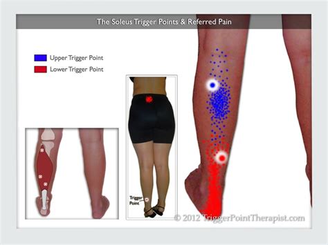 Soleus Trigger Points And Heel Pain