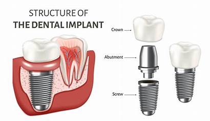 Dental Implants Many Investment Worth Implant Reasons