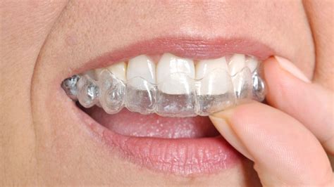 How Does Invisalign Work To Straighten Teeth Upland Dental Group And