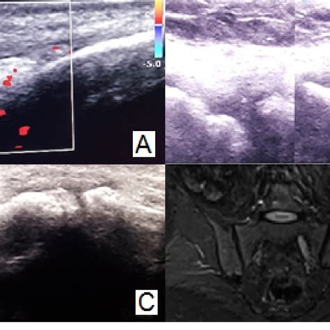 Imaging Of The Peripheral And Sacroiliac Joints In Psoriasis Pso