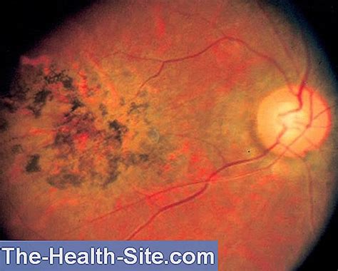 Uveitis Trigger Symptoms Treatment Prognosis 💊 Scientific Practical