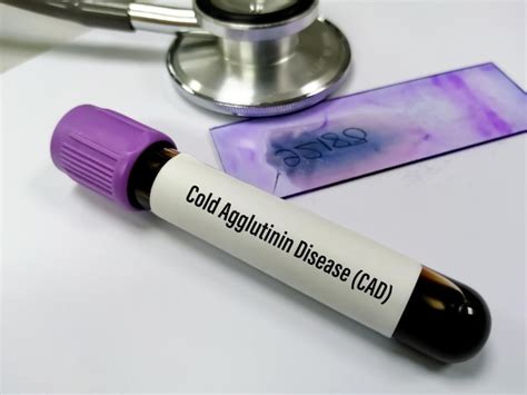 Premium Photo Blood Sample Tube For Cold Agglutinin Disease Or Cad To