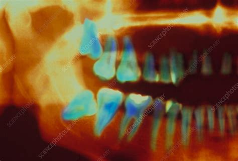 Coloured X Ray Of Impacted Wisdom Teeth Stock Image M7820083