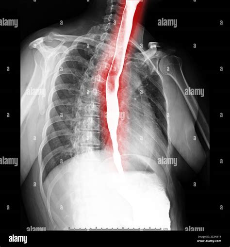 Esophagram Or Barium Swallow Oblique View Showing Esophagus For