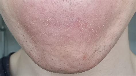 Skin Concerns How Do I Get Rid Of These White Things Around My Chin