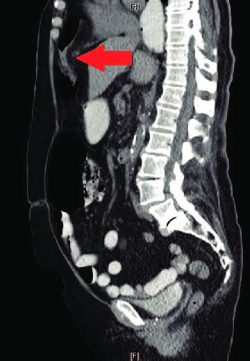 The Ct Abdomen And Pelvis With Oral Contrast From 2015 Pictured Above
