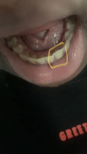 You'll wear your retainers 24 hours a day (except for eating and drinking) for the first two weeks. I broke a piece of my retainer off.. Should I still wear it?