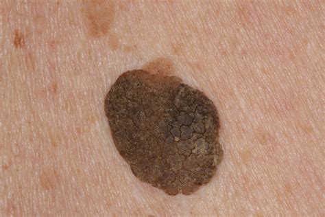 Half Of Mole Suddenly Falls Off Bleeds Scary Symptoms Zohal