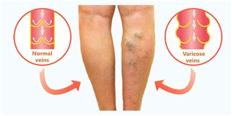 Vein Disease Causes And Risk Factors