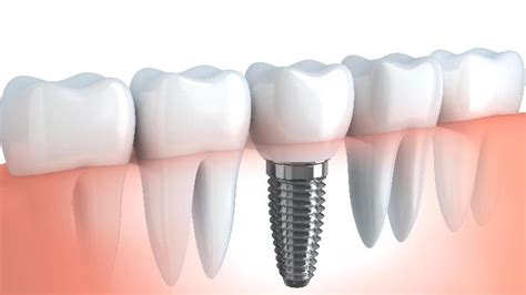 Implant Dentist Phoenix Az Dental Implant Blogs